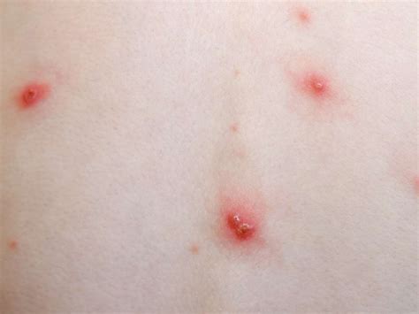 Chickenpox Symptoms Treatment Stages And Causes