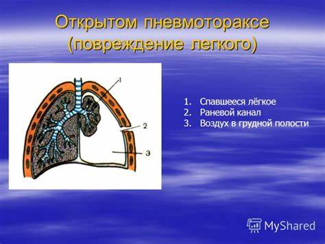 Диета при пневмотораксе легкого