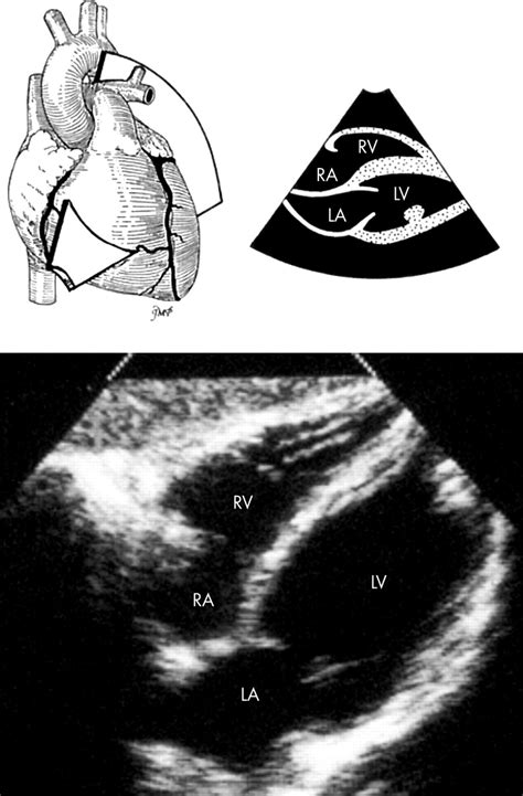 Anatomy Echocardiography And Normal Right Ventricular Dimensions Heart