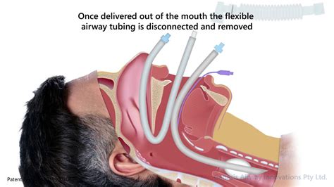Interchangeable Oral Nasal Endotracheal Tube YouTube