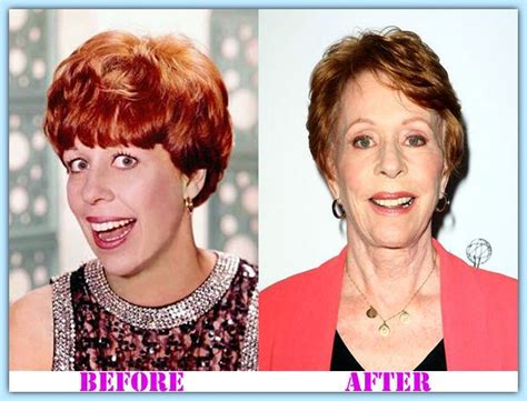 Carol Burnett Plastic Surgery Was Hilariously Recounted By Her