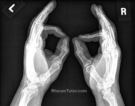 Approach To Hand X Rays · Rheumtutor