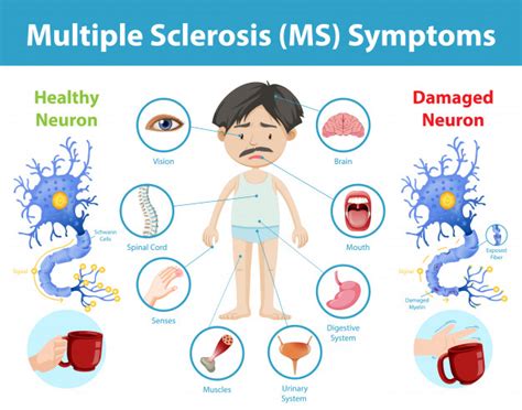 How Does Multiple Sclerosis Affect The Brain Spinal Cord And Immune