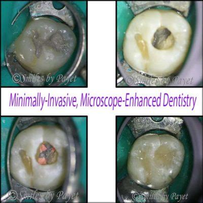 Check spelling or type a new query. Root Canal Therapy | Charlotte Dentist | Cosmetic, Laser ...