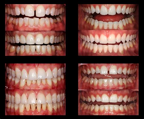 Orthodontics And Braces Transforming Smiles For All Ages