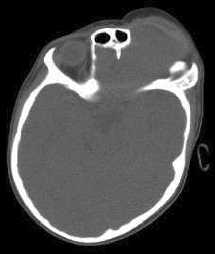 Lumps And Bumps On The Head In Children Use Of Ct And Mr Imaging In