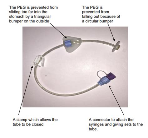 Looking After Your Percutaneous Endoscopic Gastrostomy Tube Peg Cuh