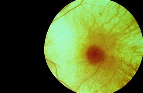Choroidal Atrophy Probable Choroideremia Retina Image Bank