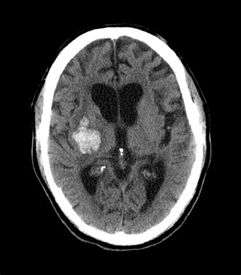 Brain Haemorrhage Mri Scan Photograph By Du Cane Medical Imaging Ltd