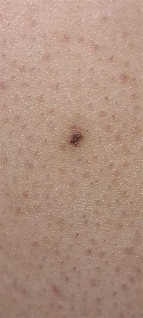 Small Scabmoleingrown Hair On Back Side Of Arm For About 4 Years Has