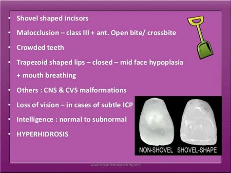 Syndromes Affecting The Palate Dental Implant Courses