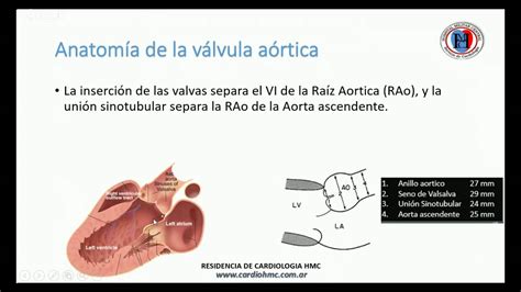 Estenosis Aortica Anatomia De La Válvula Etiologia Fisiopatologia Y