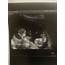 12 Week Identical Twin Ultrasound  Parentsofmultiples
