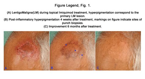 Treatment Of Lentigomaligna In Dark Skin With Topical Imiquimod Results