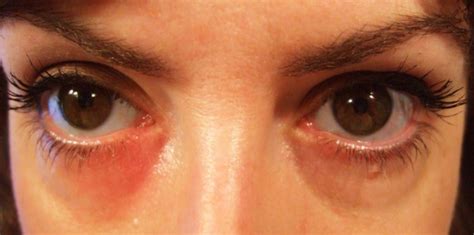 Rashes Around Eyes Pictures Pictures Photos