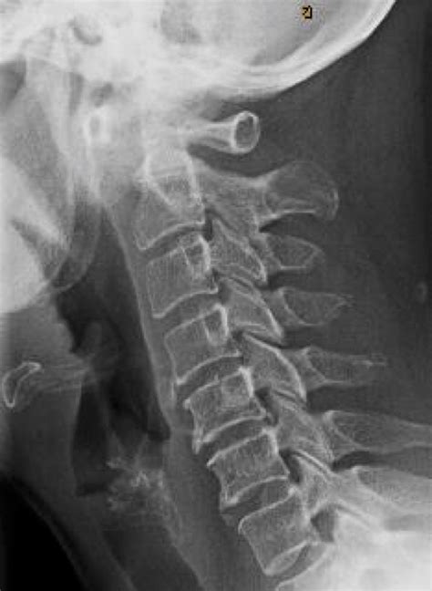Lateral Cervical Spine Standing X Ray After 3 Weeks Of Non Operative