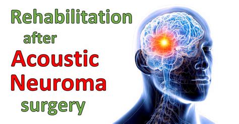 Rehabilitation After Acoustic Neuroma Surgery Or Radiation
