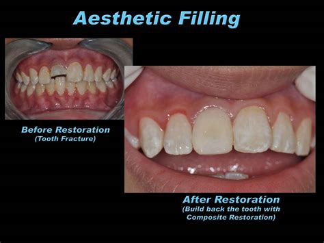 Prestige Dental Care Aesthetic Filling