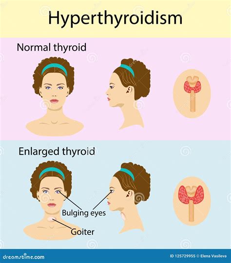 Woman With Hyperthyroidism Cartoon Vector 115995107