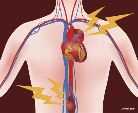 All You Need To Know About Aortic Aneurysm