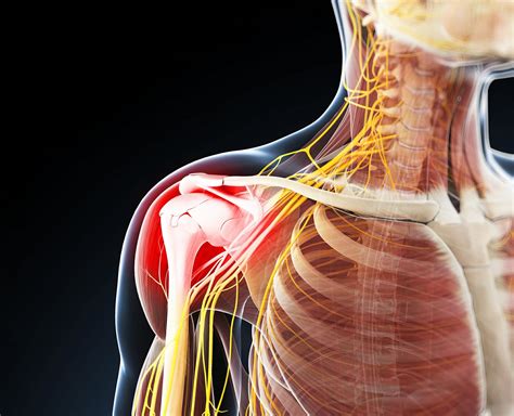 Shoulder Pain In T2d Patients Most Likely Due To Subacromial Disorders