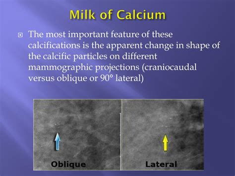 ppt breast calcifications differential diagnosis and birads powerpoint presentation id 3713492