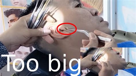 Man Gets 1gram Big Chunks Of Earwax Removed 2022 Youtube
