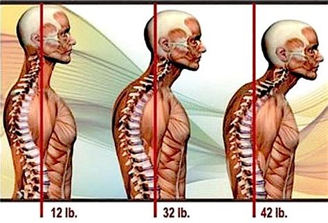 Maintaining Correct Posture Chiropractic 100