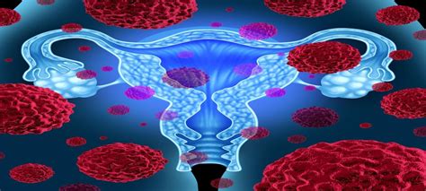 Hi, this is my first time posting, i'm worried i might have ovarian cancer, i had pain in my pelvic area for 3 months now, at times it can be very painful and hurts when i walk, or move, i've also got a bloated tummy ( i've been asked several times if i'm pregnant it's that big) also suffering with indegestion, i'm not eating but have put on some weight, my periods are every 6 weeks and a. Early detection test for ovarian cancer - QUB