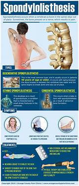 Pictures of Spondylolisthesis Physical Therapy Treatment