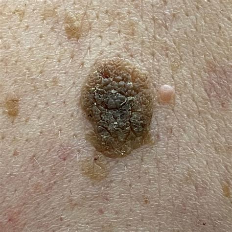 Seborrhoeic Keratoses Spot Check Skin Cancer Aesthetics Melbourne Cbd