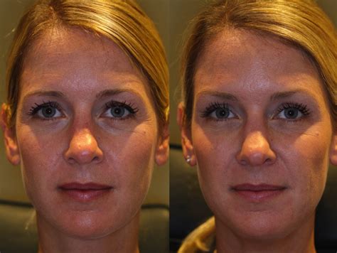 Botox Brow Lift Before And After Asian Botox Before Botox Botox