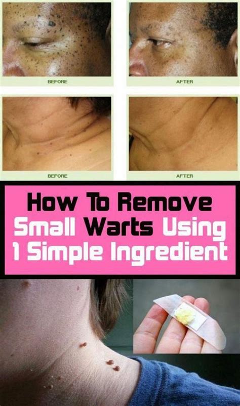 How To Remove Warts On Elbow Howtoremvo