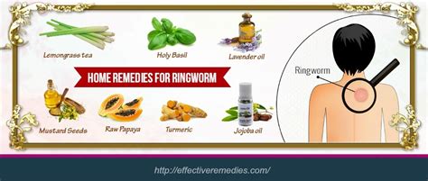 15 Best Natural Home Remedies For Ringworm In Humans