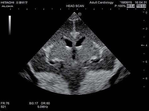 Normal Neonatal Head Ultrasound Anatomy
