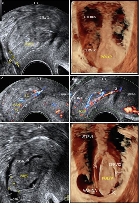 Ultrasound Evaluation Of The Cervix Obgyn Key
