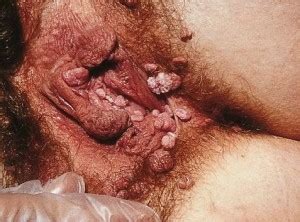 HPV Verrugas