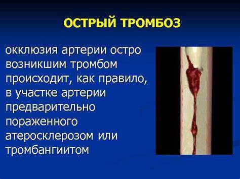 Острый тромбоз геморроидальных узлов диета