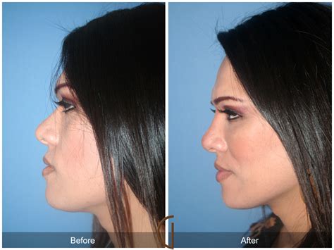 Facial Feminization Surgery Explained