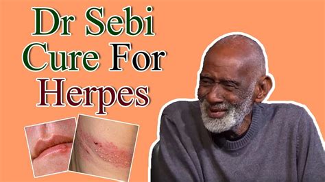 Dr Sebi Cure For Herpes Cure Herpes With Natural Herbs Youtube