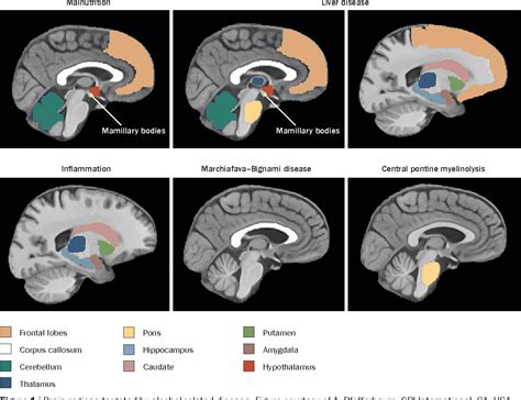 Figure 2 From Clinical And Pathological Features Of Alcohol Related Brain Damage Semantic Scholar