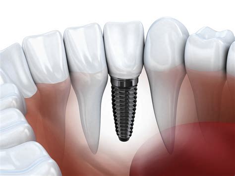 Say Goodbye To Yesterdays Iffy Dental Implants Chicago Tribune