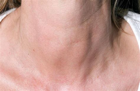 Thyroiditis Swollen Thyroids In Neck Photograph By Dr P Marazzi Science Photo Library