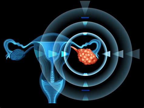 Cancerul Ovarian Tipuri Factori De Risc Etape Diagnostic Si