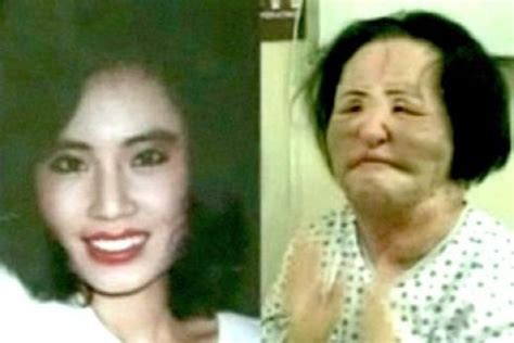 Hang Mioku Plastic Surgery Addict Injects Cooking Oil Into Her Face
