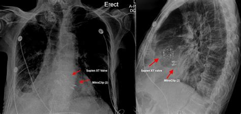 Mitraclip And Transcatheter Aortic Valve Replacement In A Patient With