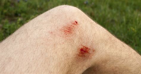 Signs And Symptoms Of Infection In A Scrape Livestrongcom