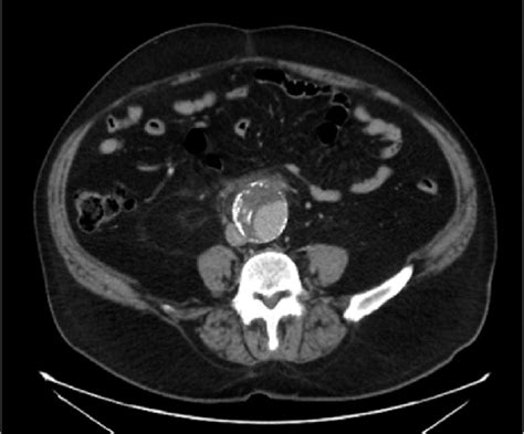 Abdominal Ct Scan Showing An Infective Abdominal Aortic Aneurysm