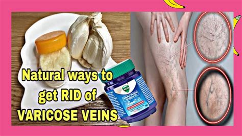 Natural Home Remedy For Varicose Veins Varicose Veins Treatment At Home Kapitbahaytv Youtube