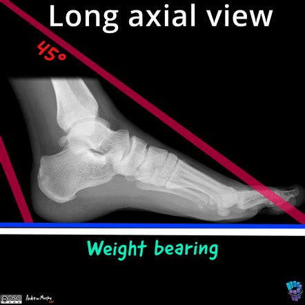 Long Axial Hindfoot Alignment View Radiology Reference Article Radiopaedia Org